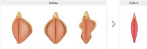 Labiaplasty