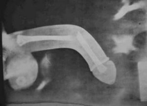 penis-fracture